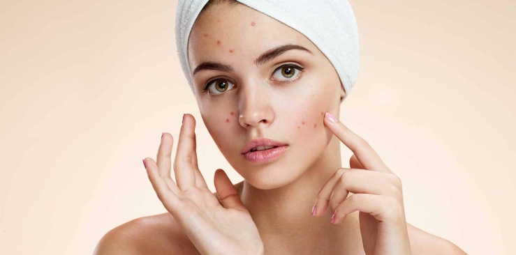 How to treat acne: natural remedies