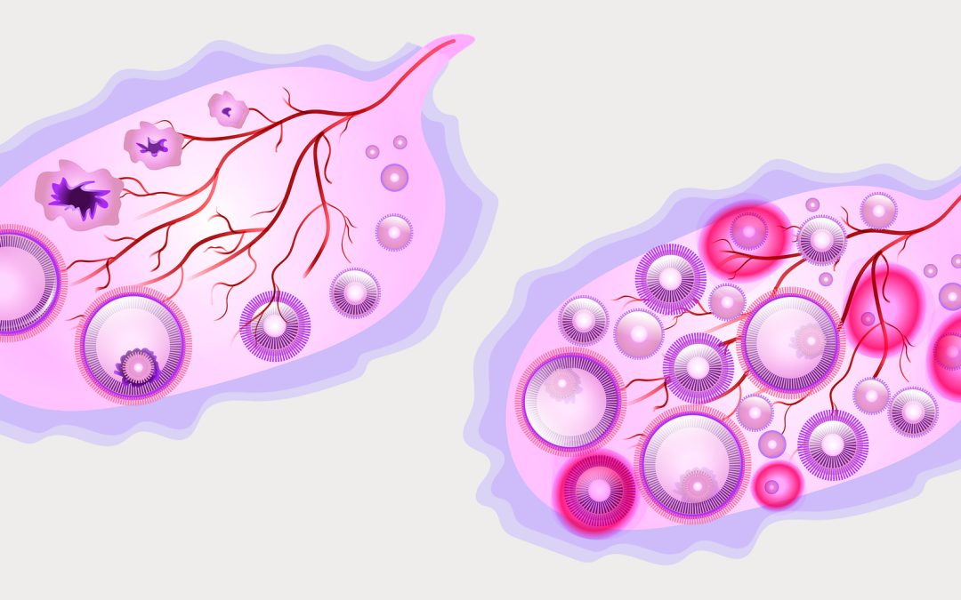 Sindrome dell’ovaio policistico: studi e rimedi naturali