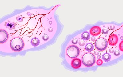 Sindrome dell’ovaio policistico: studi e rimedi naturali